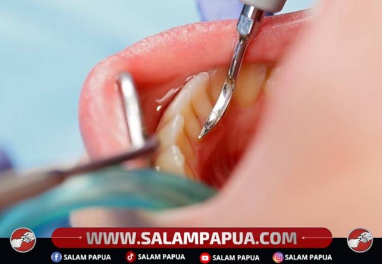 Apa Saja Efek Karang Gigi Dan Cara Mencegahnya?