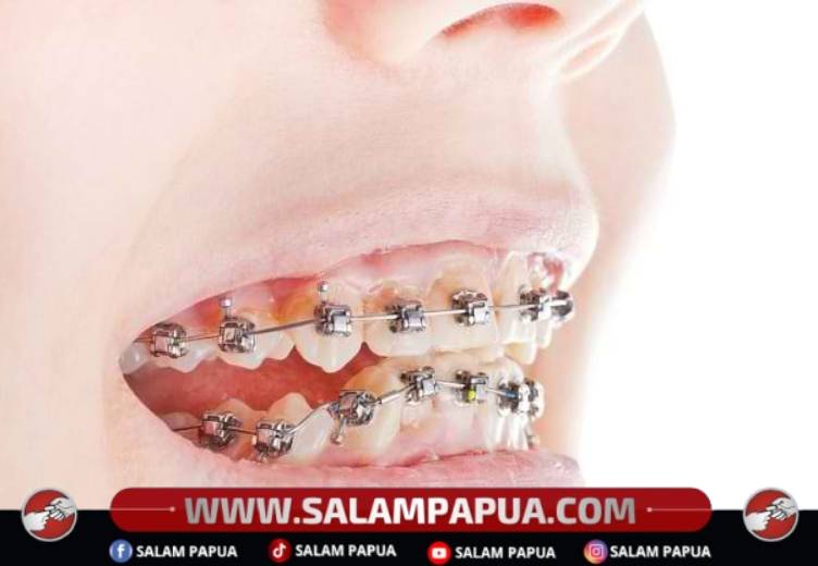 Punya Gigi Tonggos Bukan Berarti Dunia Berakhir