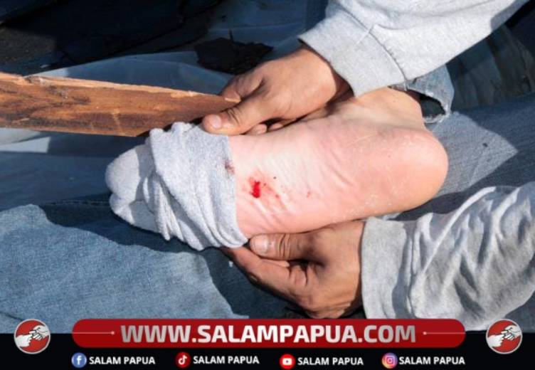Ciri-Ciri Luka Terinfeksi Tetanus Yang Harus Diwaspadai