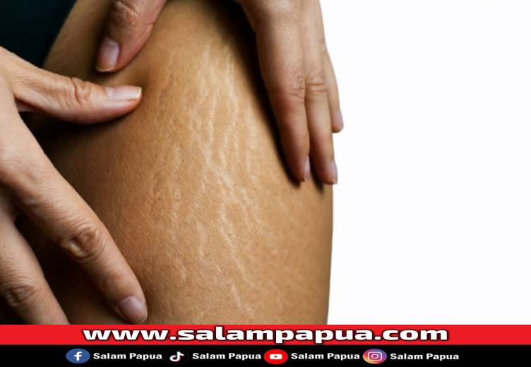7 Cara Menghilangkan Stretch Mark Pada Remaja Yang Efektif