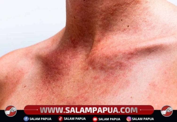 Mengenal Kulit Sensitif Dan Cara Merawatnya
