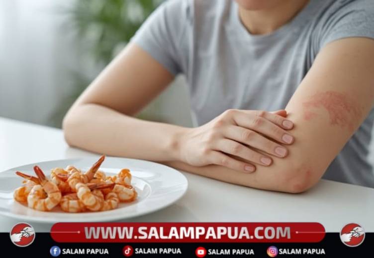 Alergi Udang, Ini Yang Perlu Diketahui
