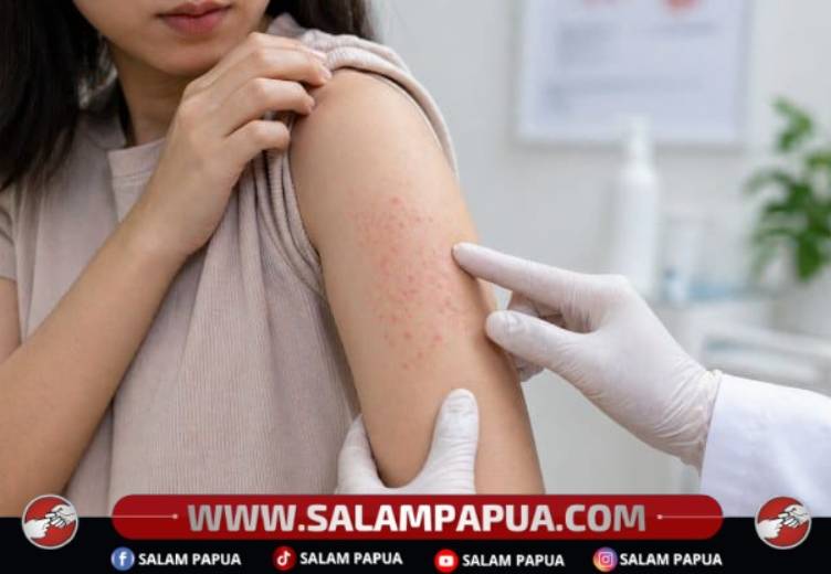 9 Penyakit Kulit Karena Virus Yang Perlu Diwaspadai