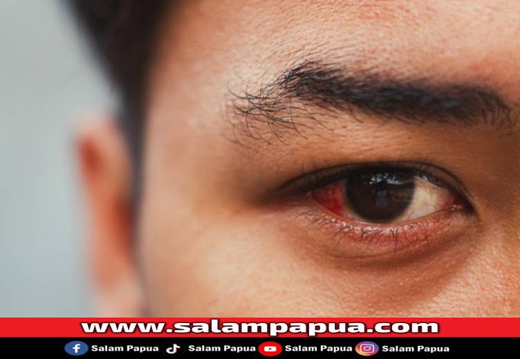Cara Mengobati Bercak Merah Pada Mata Dengan Cepat