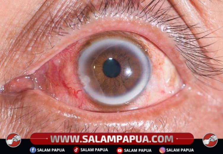 Arcus Senilis, Munculnya Lingkaran Putih Pada Mata