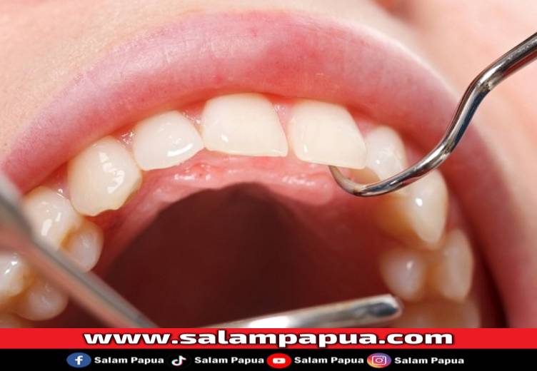 6 Cara Menghilangkan Plak Pada Gigi Yang Mudah Dan Praktis