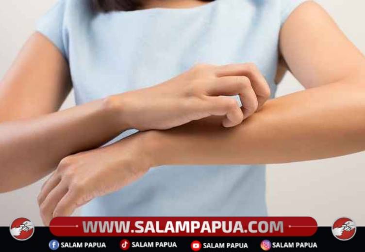 Berbagai Cara Menghilangkan Bekas Gigitan Nyamuk