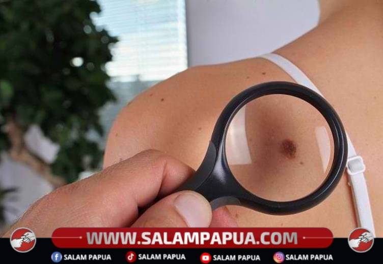 4 Fakta Daging Tumbuh Yang Perlu Diketahui